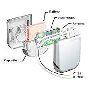 implantable defibrillator